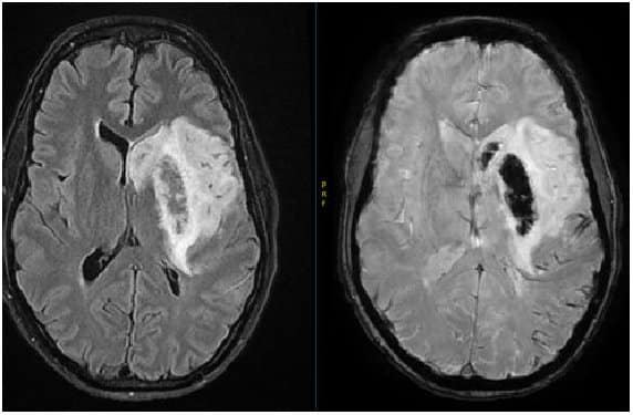 Feb 2017 Brain MRI showing an ischemic stroke that underwent a hemmorhagic conversion