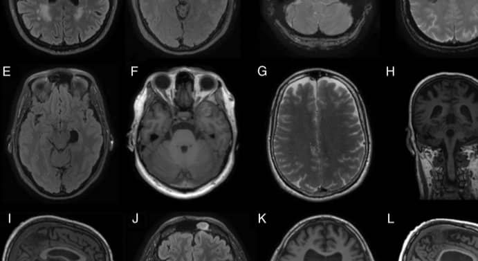 Stroke studies, 7/21, #6